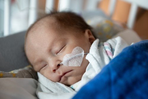 A baby being fed by NG tube