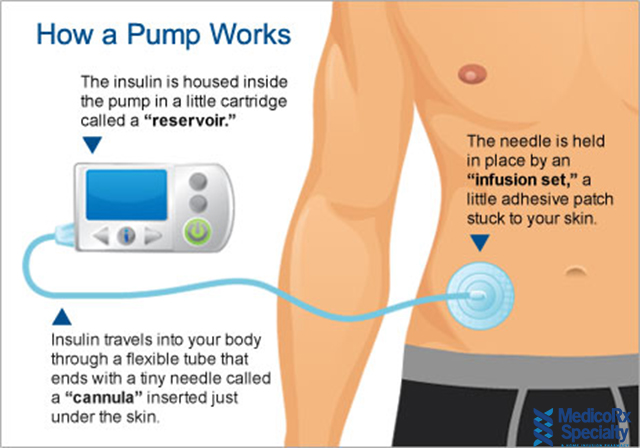 Image that explains how a pump works