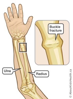 Diagram showing the bones in a forearm, pointing to a buckle fracture on the radius near the wrist