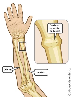 Fracture en motte de beurre